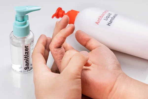 Kulit kering di jari dengan botol cairan antibakteri cuci tangan dan pembersih tangan. Pencucian tangan yang sering terjadi menyebabkan kekeringan kulit — Stok Foto