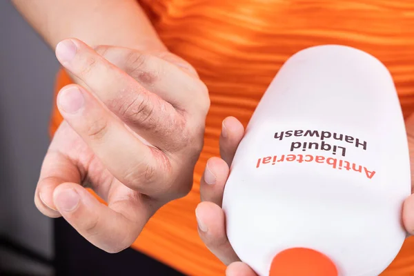 Dry skin on finger with bottle of antibacterial liquid handwash. Frequent hand washing causes skin dryness — Stock Photo, Image