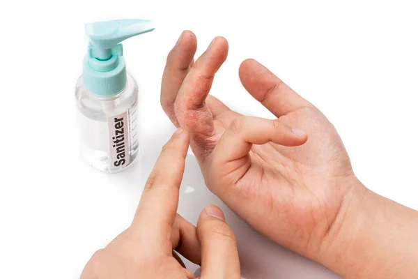 Dedo de piel seca con botella de desinfectante de manos. El desinfectante causa sequedad con uso frecuente — Foto de Stock