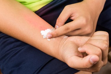 Kabartma tozu döküntüleri kaşıntı rahatlatmak için kullanılan.