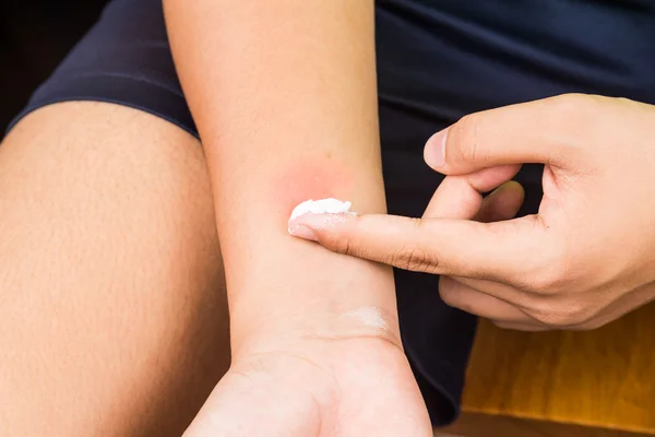 Baking soda wordt gebruikt voor het verlichten jeuk van insectenbeten. — Stockfoto