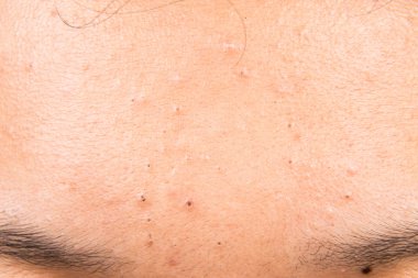 Sivilce siyah nokta bir gencin alnına closeup