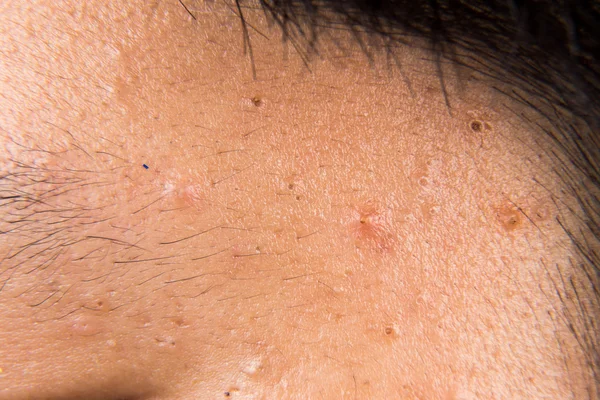 Closeup of pimple blackheads on the temple forehead of a teenager — Stock Photo, Image
