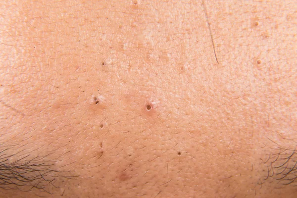 Closeup of pimple blackheads on the forehead of a teenager — Stock Photo, Image