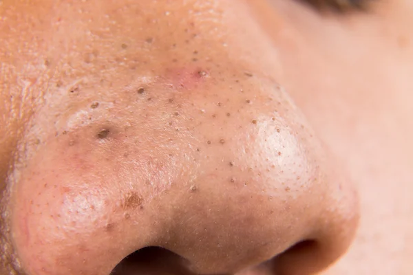 Closeup pupínek černé tečky na nose teenager — Stock fotografie