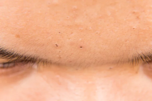 Pimple blackheads na testa de um adolescente — Fotografia de Stock