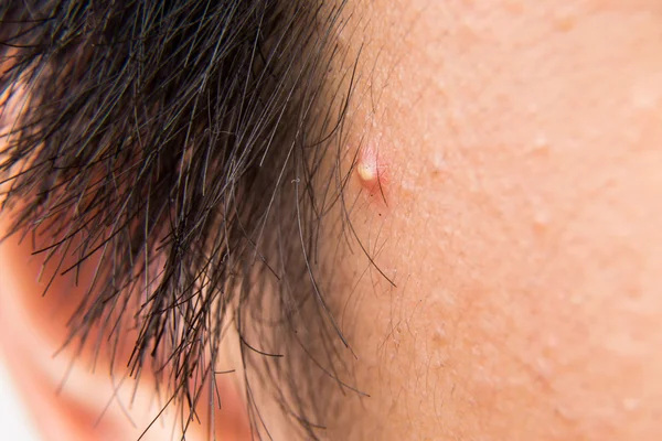 Fechar a espinha de acne no templo de um adolescente — Fotografia de Stock