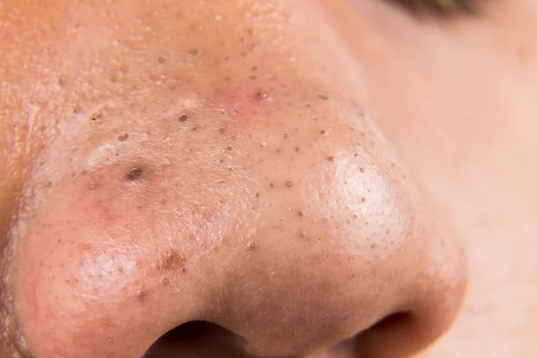 Blackheads Pictures, Images, Stock Photos | Depositphotos® Blackheads Pictures, Images, Stock Photos | Depositphotos®