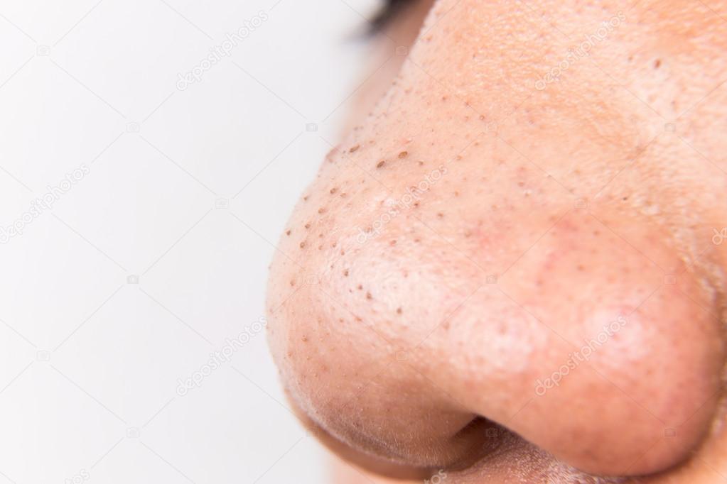 Closeup of pimple blackheads on the nose of a teenager