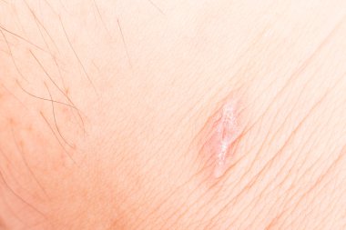 Bacak kurtarma üzerine bir yara izi üzerinde Kapat