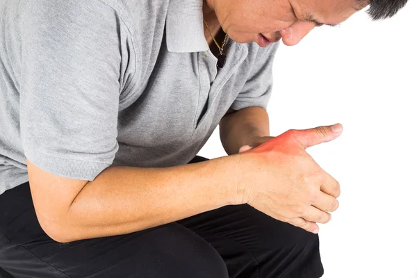 Hombre con gota dolorosa e inflamada en la mano alrededor del área del pulgar. — Foto de Stock