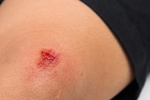 Ferida de hematoma no joelho — Fotografia de Stock