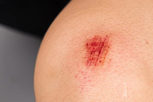 Close up on bloody bruise wound on the knee — Stock Photo, Image