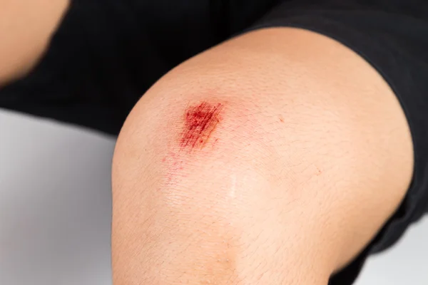 Bloody bruise wound on the knee — Stock Photo, Image