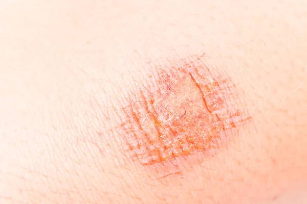 Close-up em ferida dolorosa no joelho — Fotografia de Stock