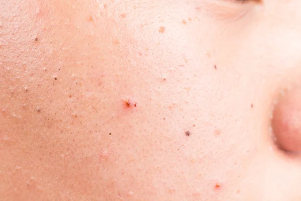 Close up on pimple blackheads on the cheek of a teenager — Stock Photo, Image