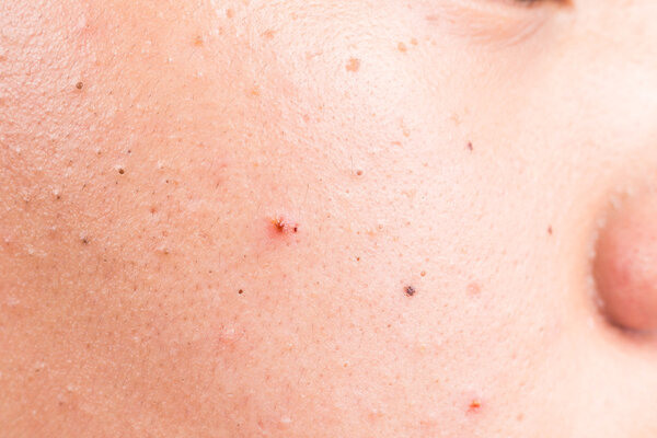 Close up on pimple blackheads on the cheek of a teenager