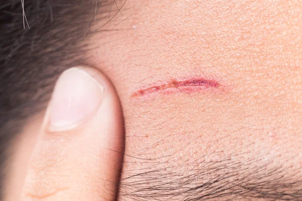 Пальцы, обнимающие болезненную рану на лбу от глубокого пореза — стоковое фото