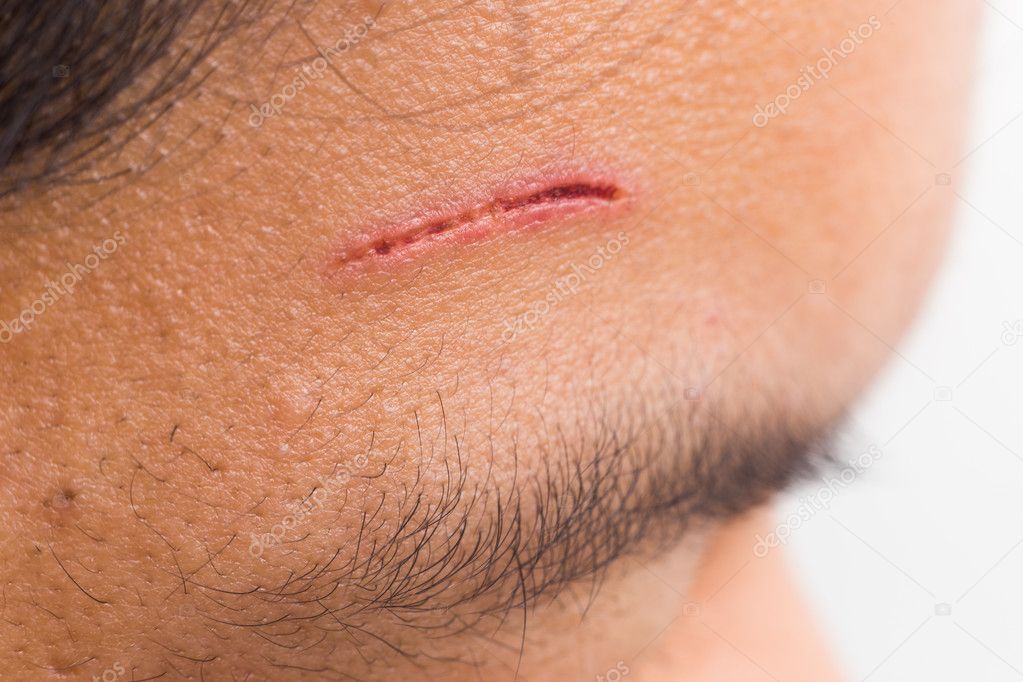 Close up of painful wound on forehead from deep cut