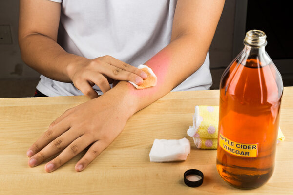 Apple cider vinegar effective natural remedy for skin itch, fung