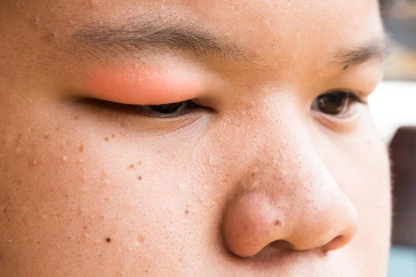 Опухшая красная верхняя крышка глаза с началом стальной инфекции — стоковое фото