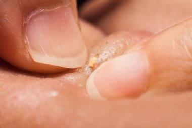 Parmak çivi kullanarak bir gencin burun sivilce siyah nokta sıkma