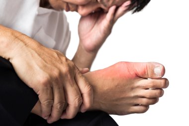 Man with painful and inflamed gout on his foot around the big toe area. clipart