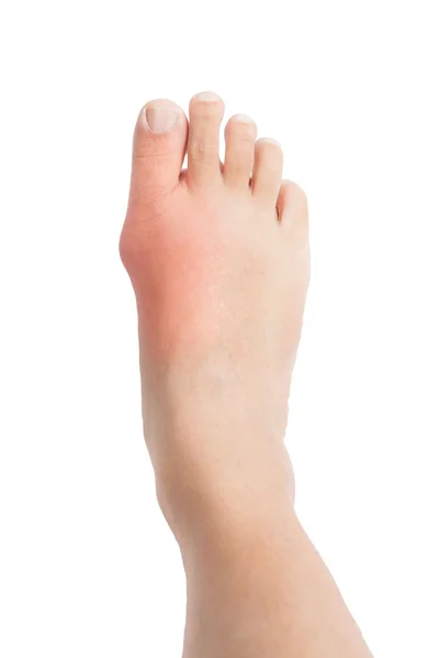 นิ้วเท้าใหญ่ผิดรูปเนื่องจากการอักเสบของโรคเกาต์ที่เจ็บปวด — ภาพถ่ายสต็อก