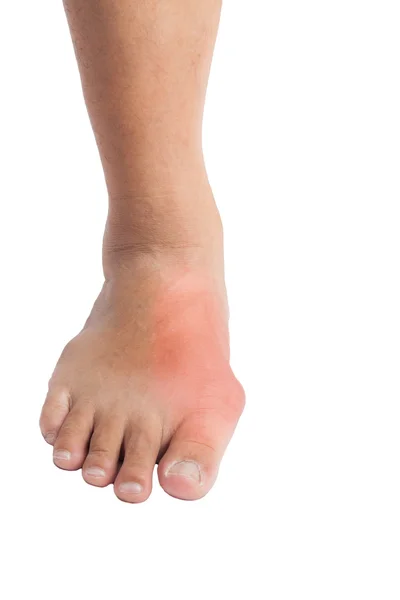 Деформированный большой палец ноги из-за болезненного воспаления подагры — стоковое фото