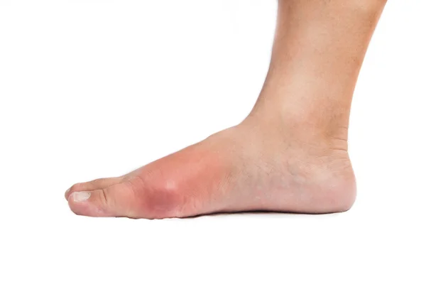 Деформированный большой палец ноги из-за болезненного воспаления подагры — стоковое фото