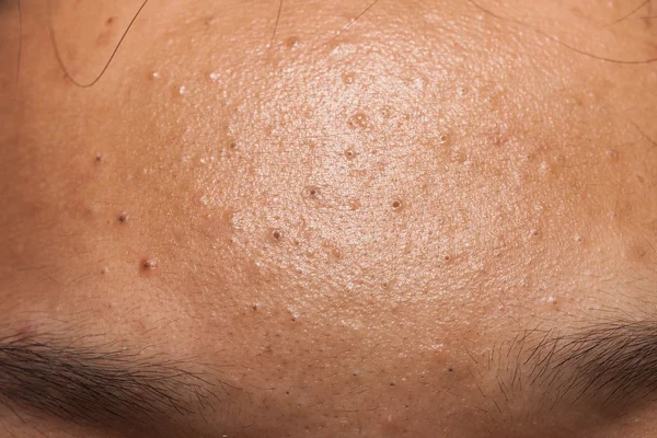 Pimple blackheads on the forehead of a teenager — Stock Photo, Image