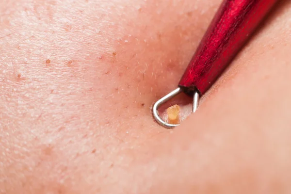 Squeezing pimple blackheads from the face of a teenager using a pimple popper — Stock Photo, Image