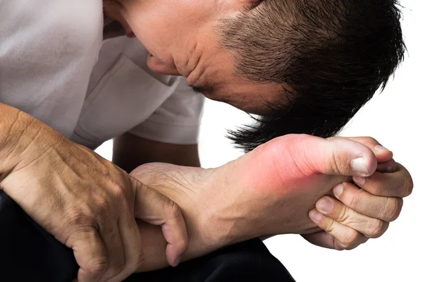 Homem com gota dolorosa e inflamada no pé em torno da área do dedo do pé grande. — Fotografia de Stock