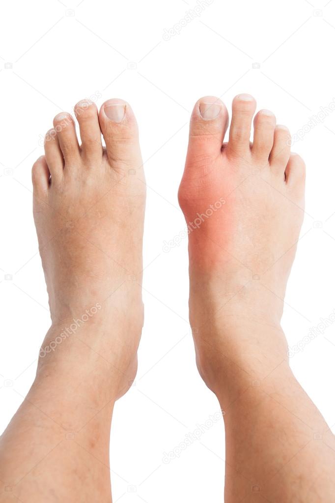 Pair of feet with deformed right toe due to painful gout inflammation.