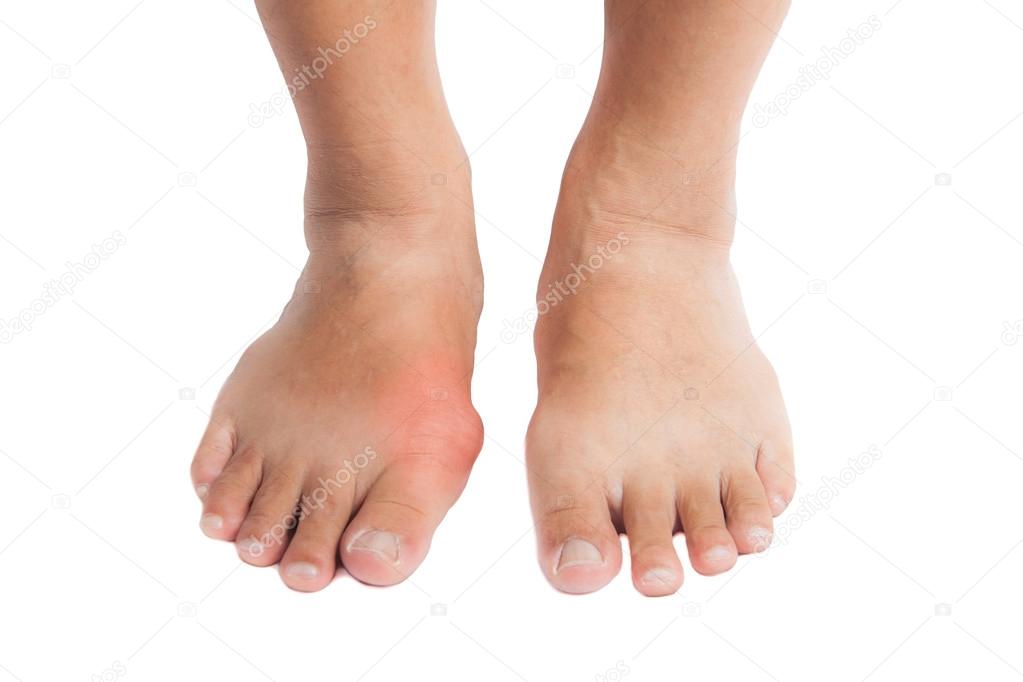 Pair of feet with deformed right toe due to painful gout inflammation.