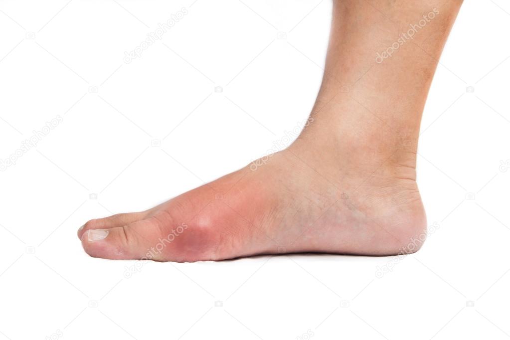 Deformed big toe due to painful gout inflammation