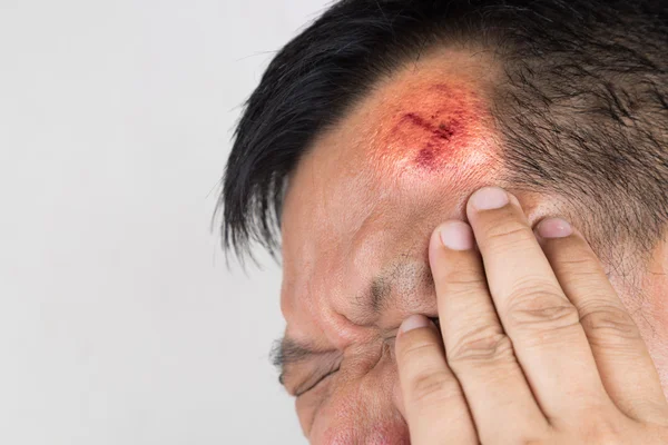 Szelektív összpontosít a sérülés fájdalmas vörös, duzzadt homlok — Stock Fotó