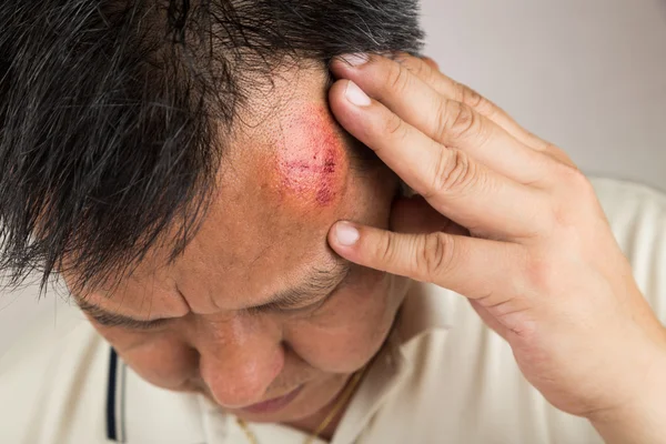 Selektiver Fokus auf schmerzhafte rote geschwollene Stirn — Stockfoto