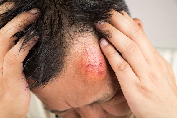 Selectieve aandacht op pijnlijke rode gezwollen voorhoofd letsel — Stockfoto