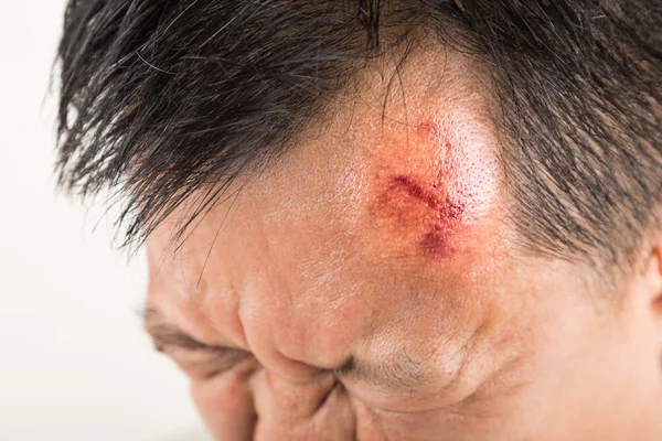 Foco seletivo em lesão dolorosa na testa inchada vermelha — Fotografia de Stock