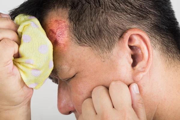 Man behandelen zijn gewonde pijnlijke gezwollen voorhoofd hobbel met icepack — Stockfoto