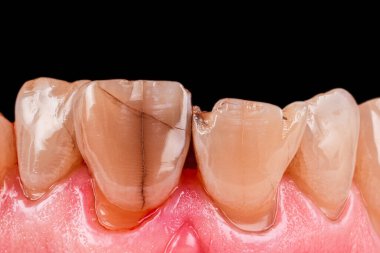 Çatlaklı dişler geri getirilecek