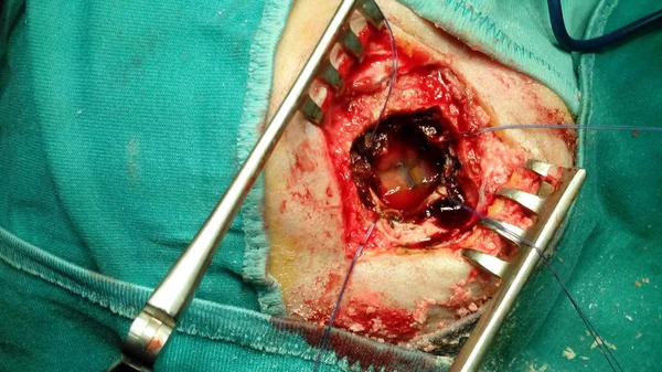 Kronik subdural hematom — Stok fotoğraf