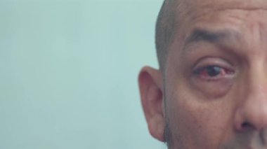 Bir adam yavaşça Pterygium ameliyatından sonra sağ gözünü gösterir..