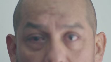 Yüzü ortadan ikiye bölünmüş, yeni ameliyat edilmiş sağ gözünü ortaya koyan bir insan.