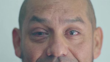 Bir adam sağ gözündeki pterygium için ameliyat olduktan sonra kameraya gülümsüyor..