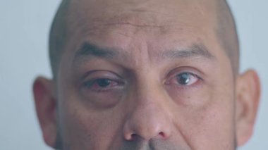 Bir adam başını kameraya çevirir ve sağ gözünü gösterir. Bu da yakın zamanda bir pterygium için ameliyat edilmiştir.