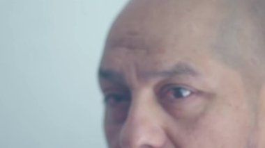 Sağ gözü Pterygium için yapılan göz ameliyatından dolayı şişmiş bir adam kameraya bakar..