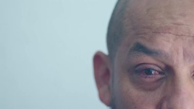 Hasta doğrudan kameraya bakıyor. Sağ gözünün yakın çekimini gösteriyor. Pterygium için ameliyat olmuş.