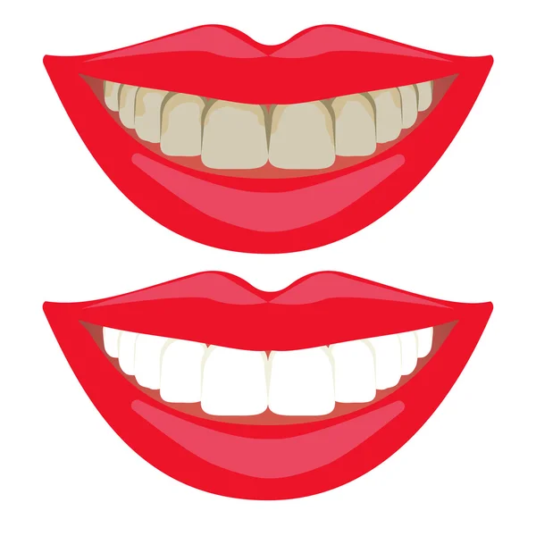 Whitening teeth results. Before and after dental bleaching — Stock Vector